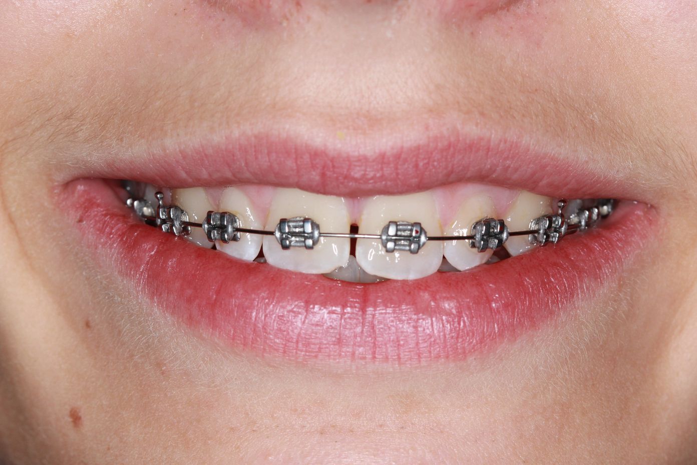 Metal Braces