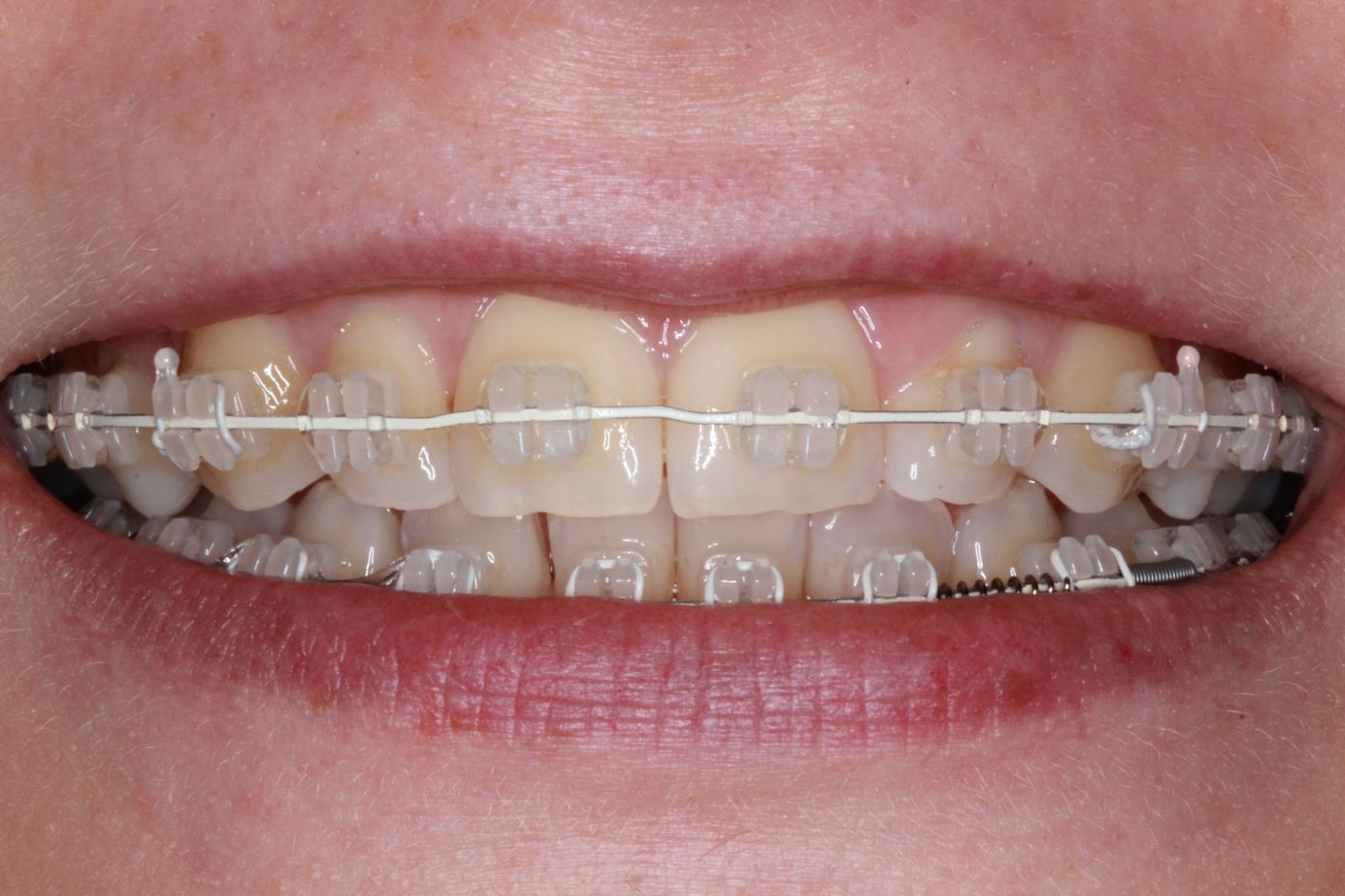 Ceramic Braces - Cost of Treatment - Kingston Orthodontics