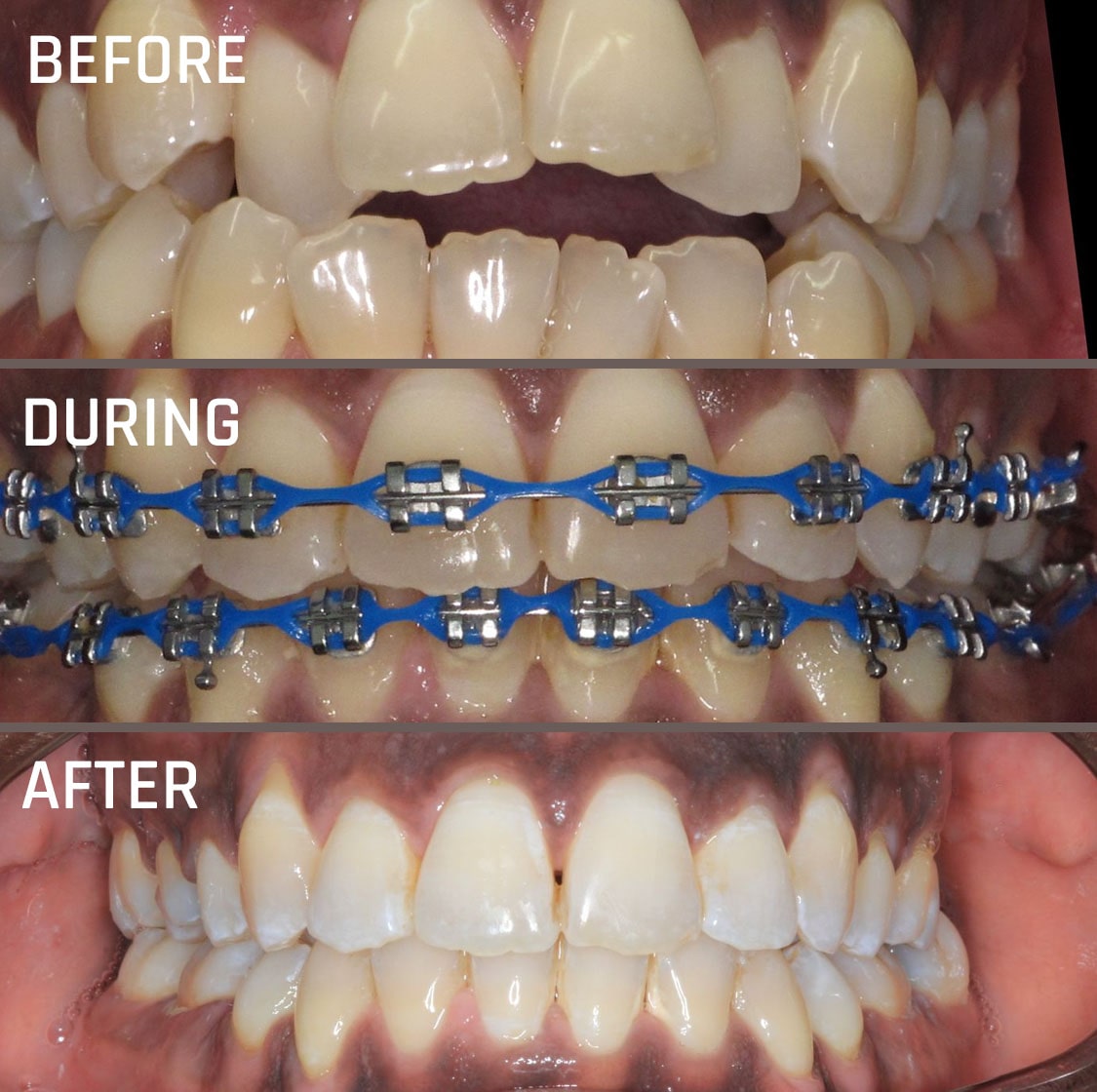 Metal Braces - Traditional Braces Cost - Kingston Orthodontics