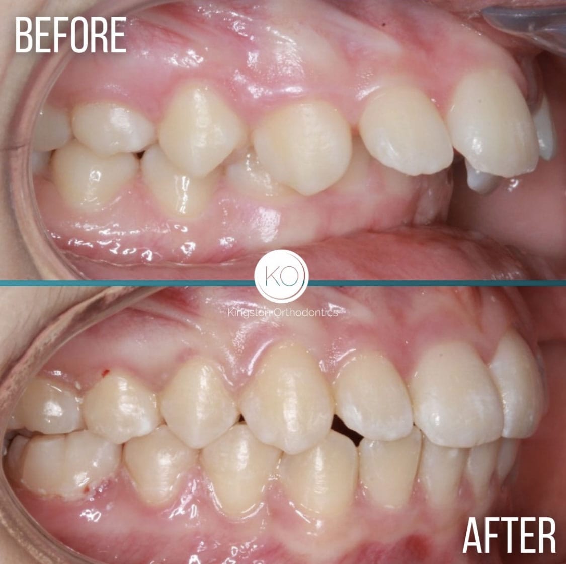 Overbite Braces Process