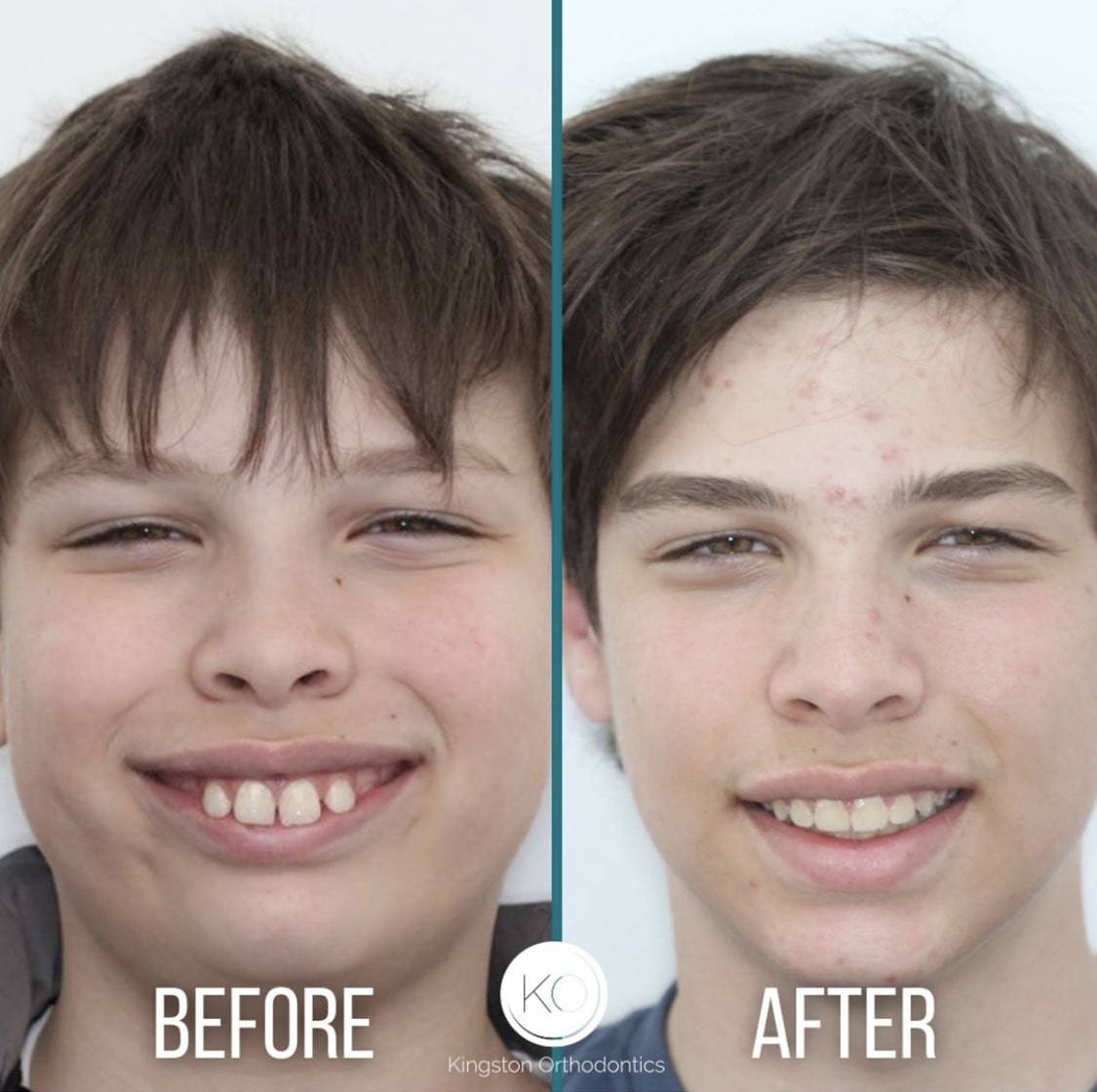 How Do You Fix an Overbite? - Burke & Beckstrom Orthodontics