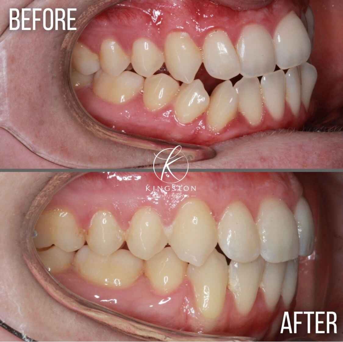 Underbite Causes Treatment Option