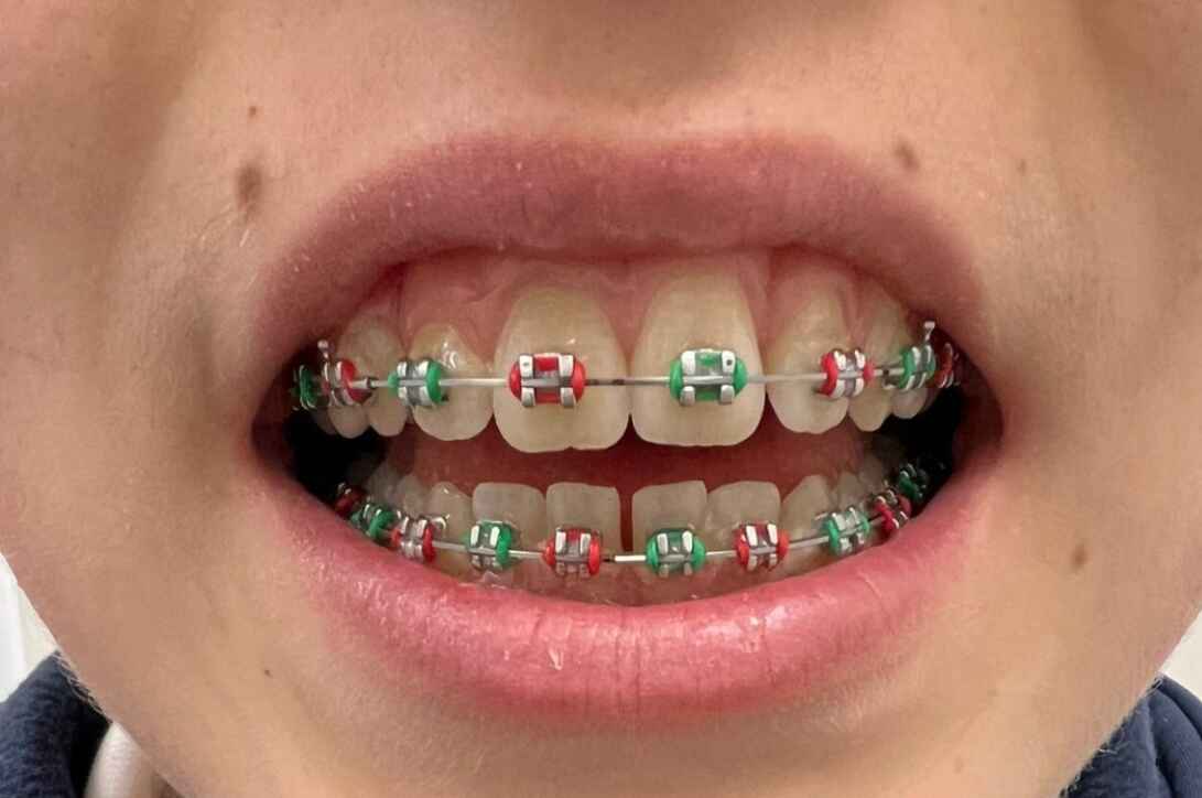 Metal braces in a child with coloured elastics