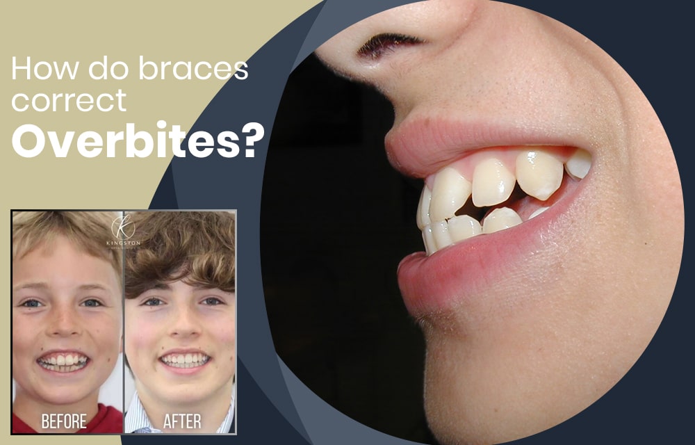 How Do BRACES FIX Overbites?, Overbite Before and After Braces